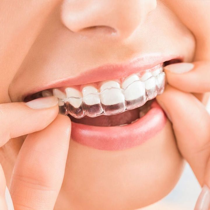 teeth alignment with orthodontic braces